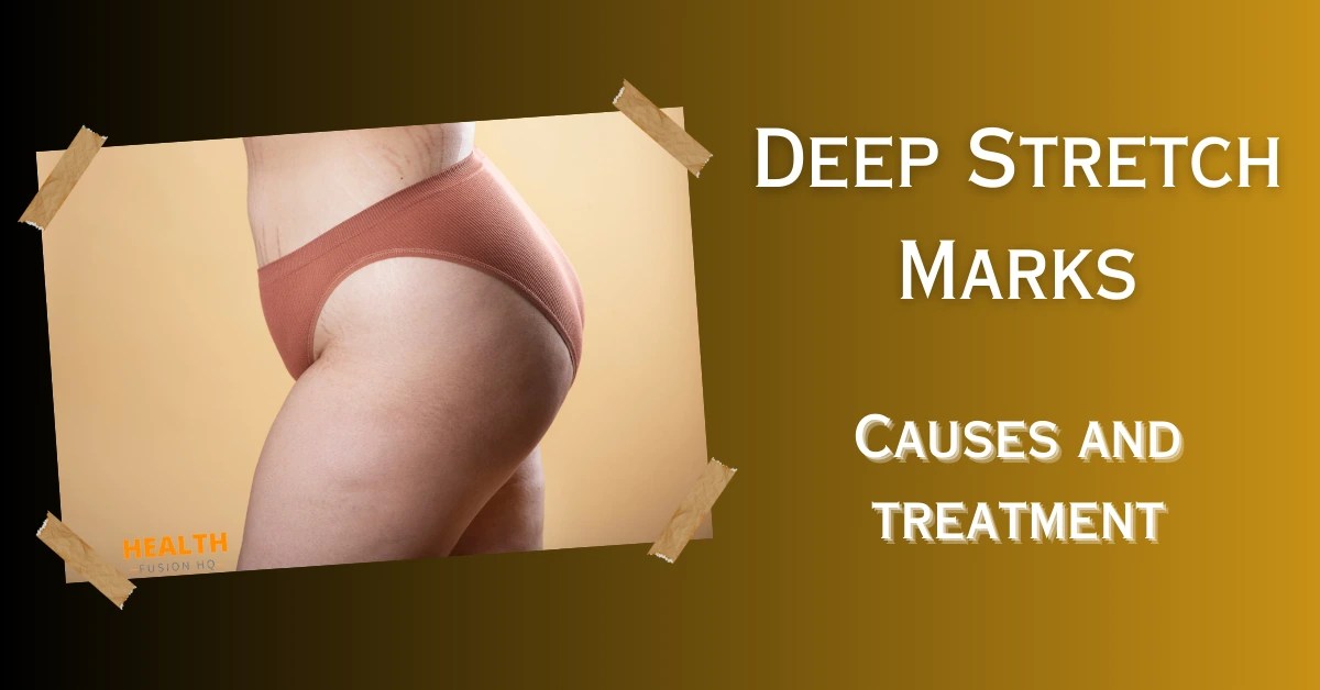 Deep Stretch Marks Understanding The Root Causes And Effective