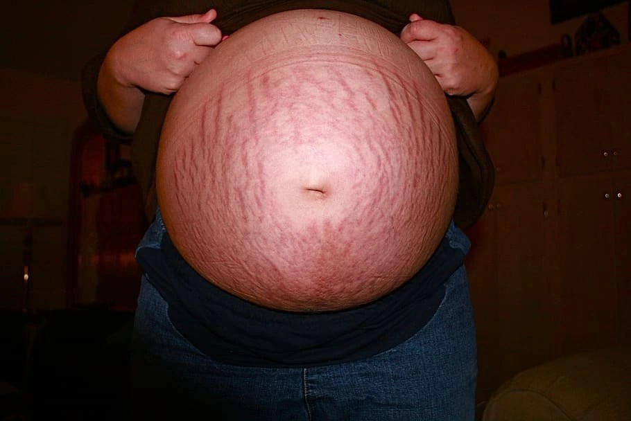 Deep Stretch Marks Understanding The Root Causes And Effective