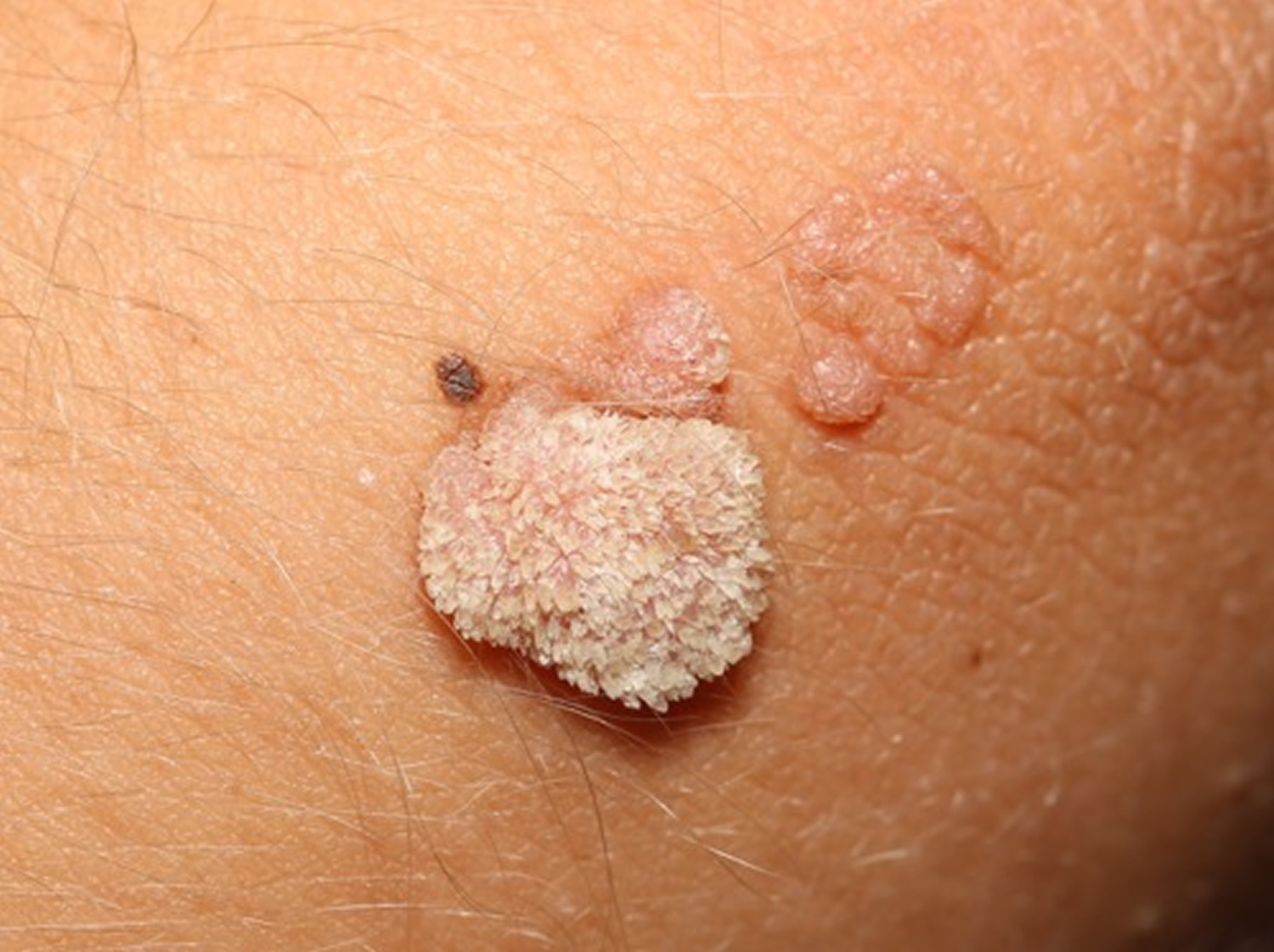 Warts Plantar Wart Wart On Finger, Hands, Face Wart Treatment
