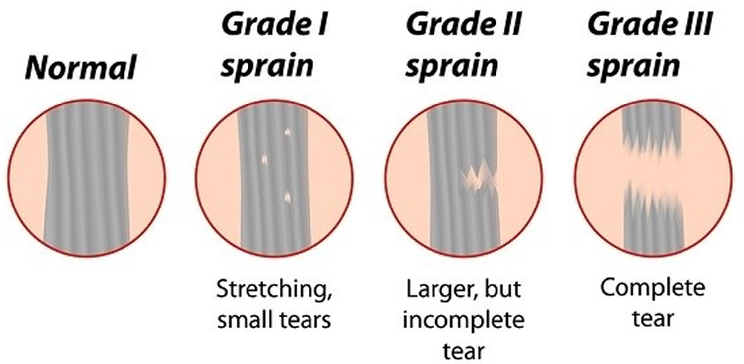 Hamstring Injury Causes, Symptoms, Recovery Time & Treatment