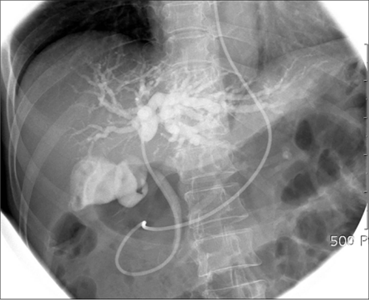 ERCP Procedure Indications, Recovery, Complications