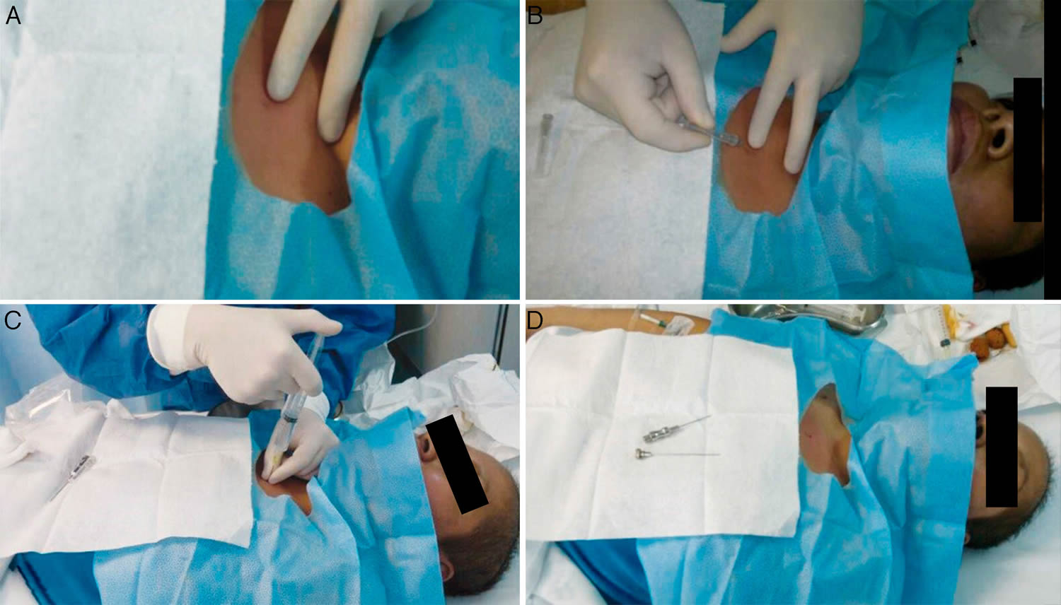 Bone Marrow Biopsy Reasons, Pain, Complications
