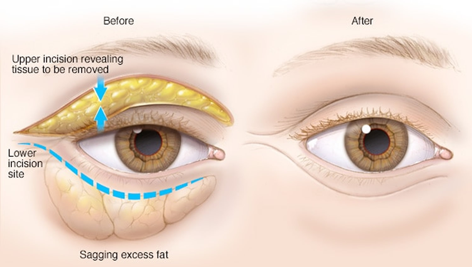 Eyelid Surgery Upper & Lower, Blepharoplasty Surgery, Recovery