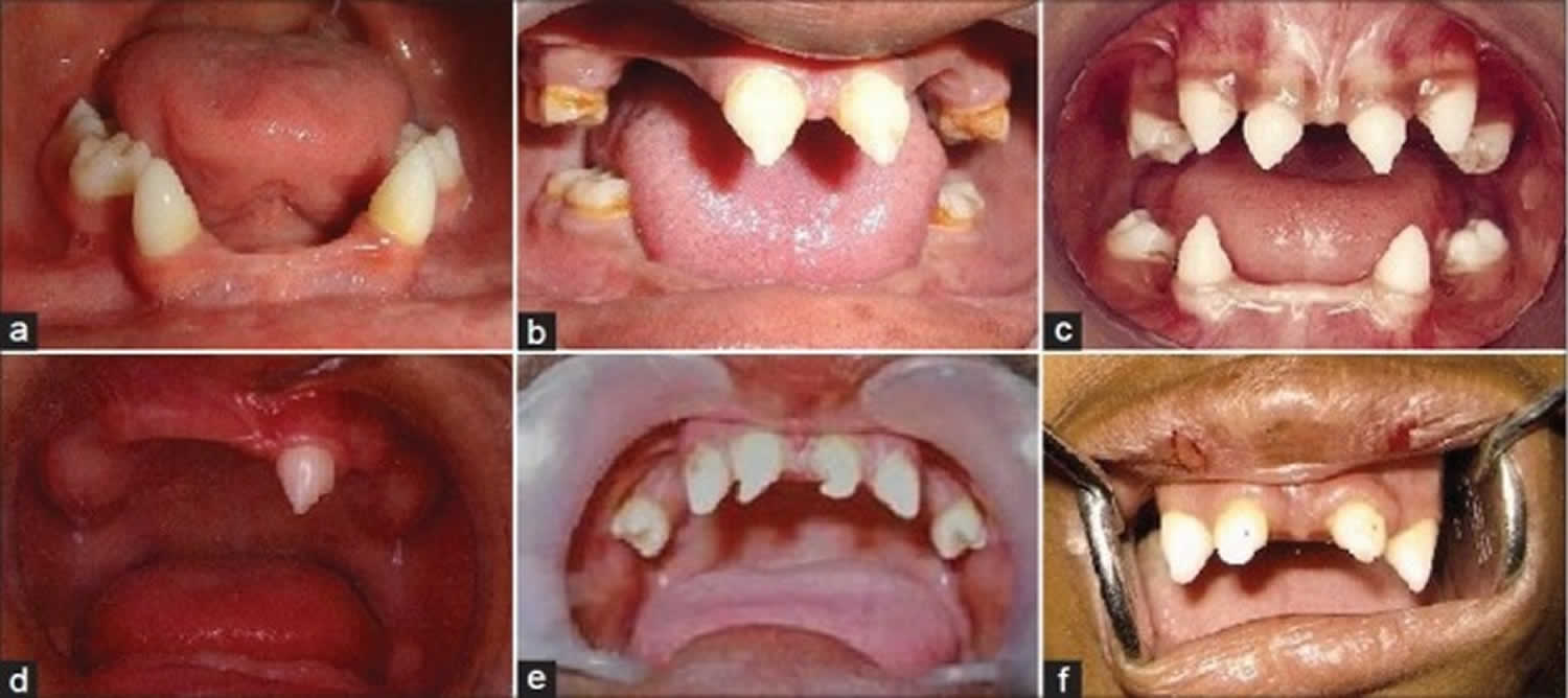 Ectodermal dysplasia causes, types, symptoms, diagnosis and treatment
