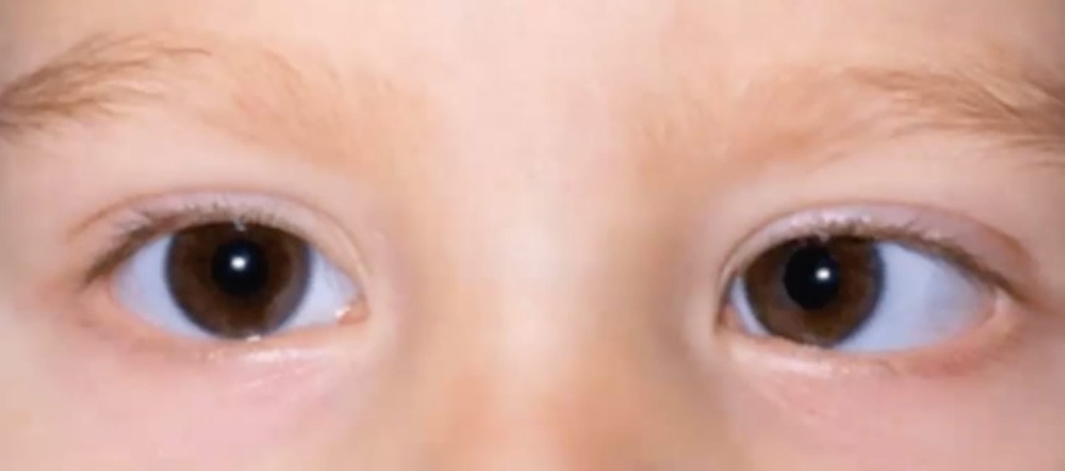 Strabismus causes, symptoms, diagnosis, strabismus treatment & surgery