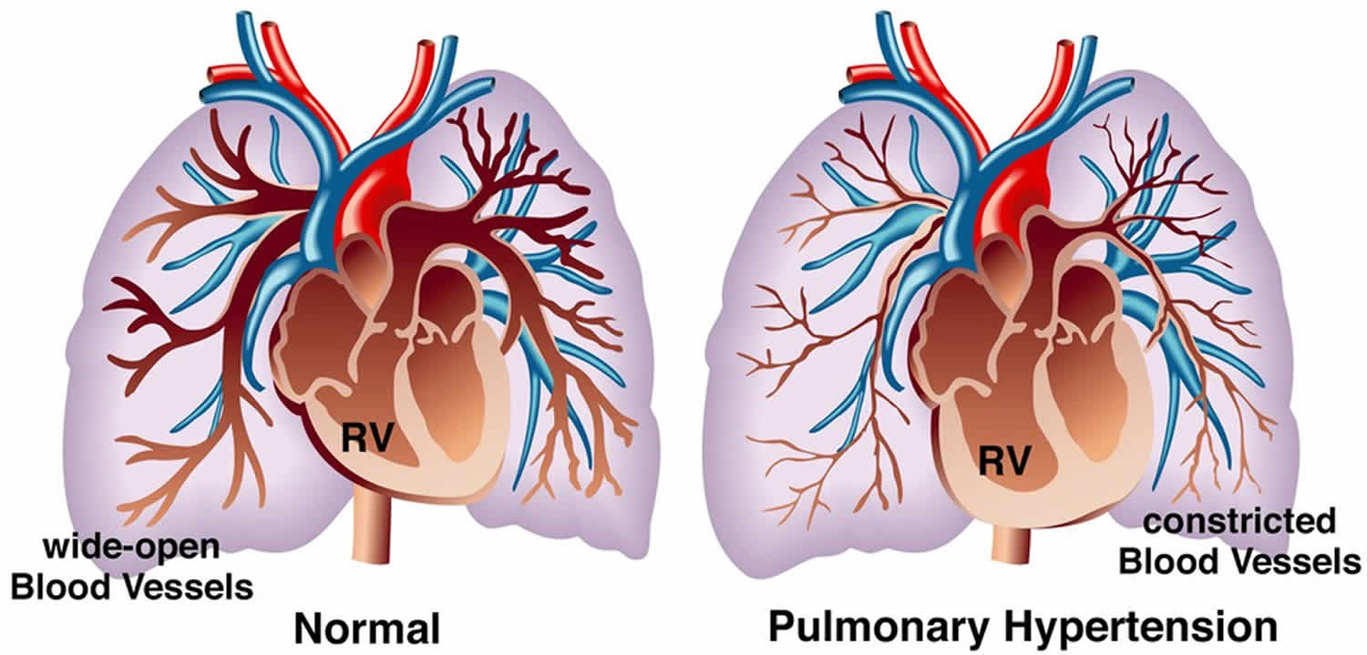 Pulmonary hypertension & pulmonary arterial hypertension causes, symptoms & treatment