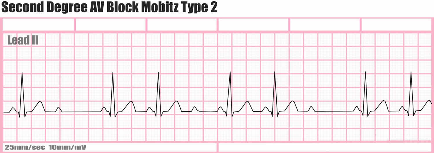 Heart block causes, symptoms, types, diagnosis and heart block treatment