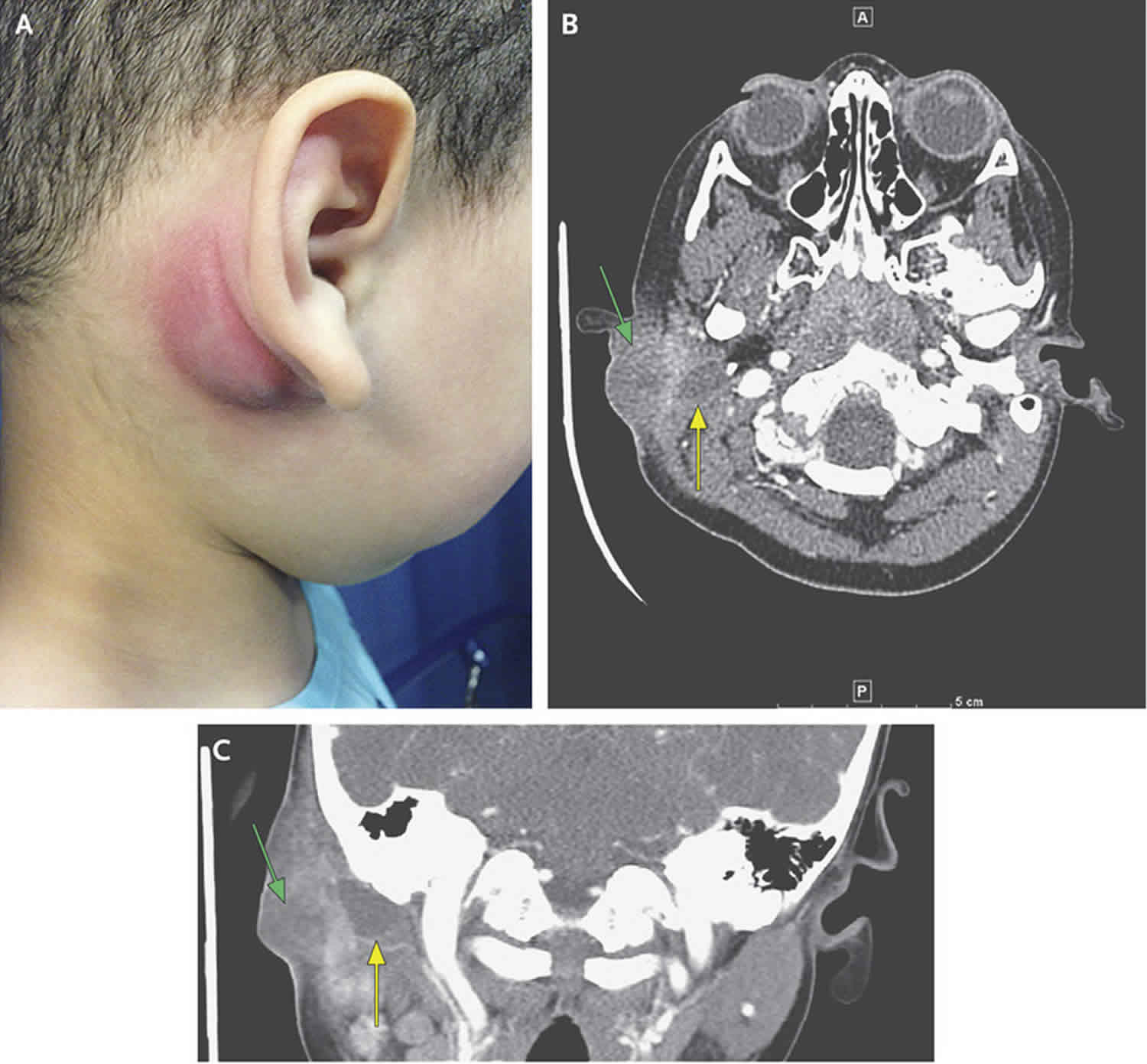 Branchial cleft cyst causes, types, signs, symptoms, diagnosis & treatment