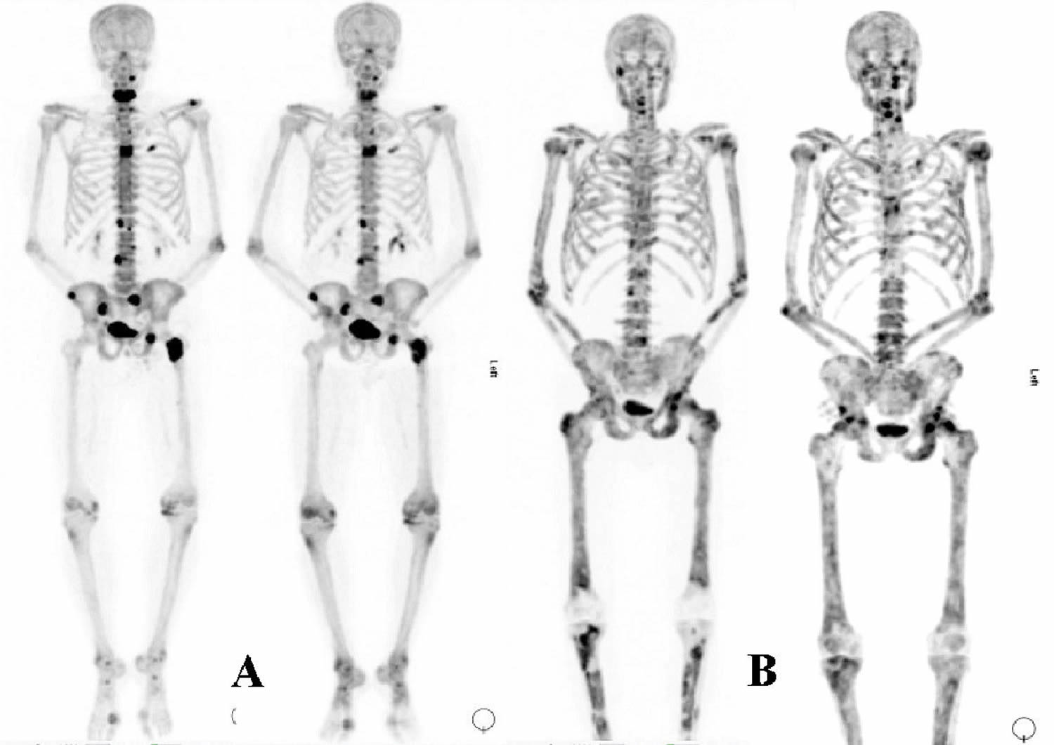 Bone Metastasis Cancer Symptoms, Life Expectancy, Treatment