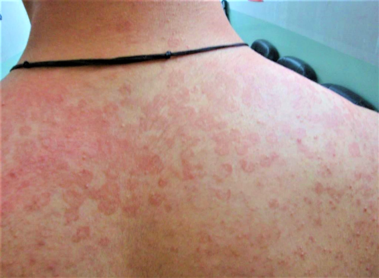 Tinea Versicolor Causes, Signs, Symptoms, Treatment & Remedies(03)