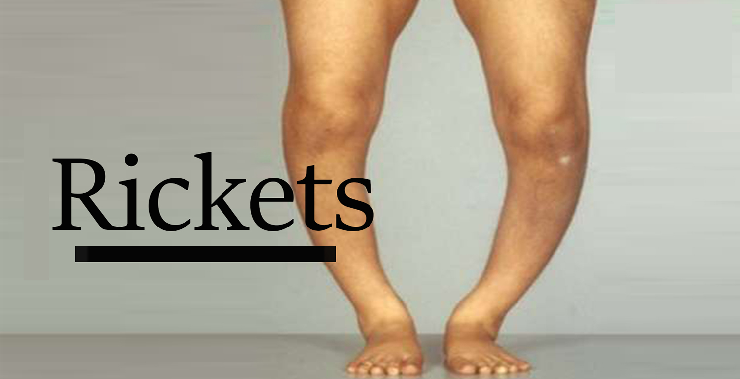Rickets Causes, Symptoms, Diagnosis, Prevention, Treatment
