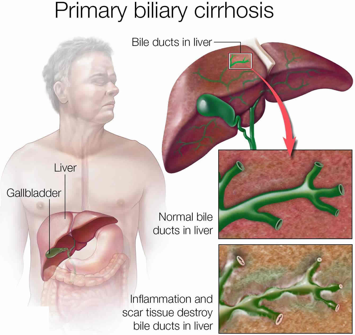 Primary biliary cholangitis causes, symptoms, life expectancy, diet & treatment