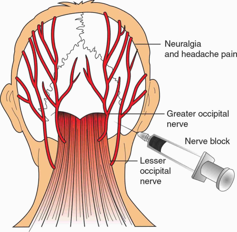 Nerve block uses, duration, nerve block procedure & side effects