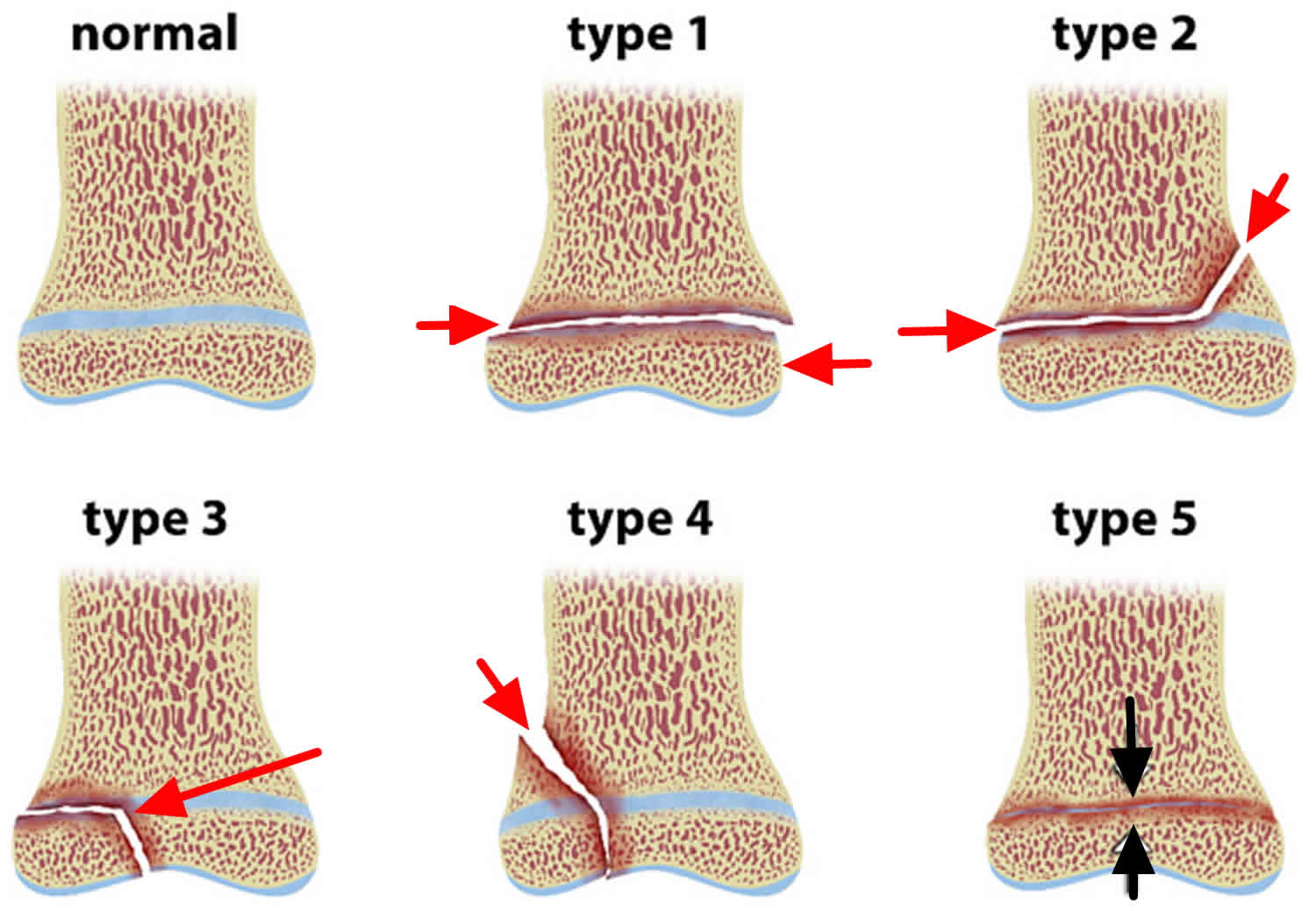 Salter Harris fracture definition, types, symptoms, diagnosis & treatment