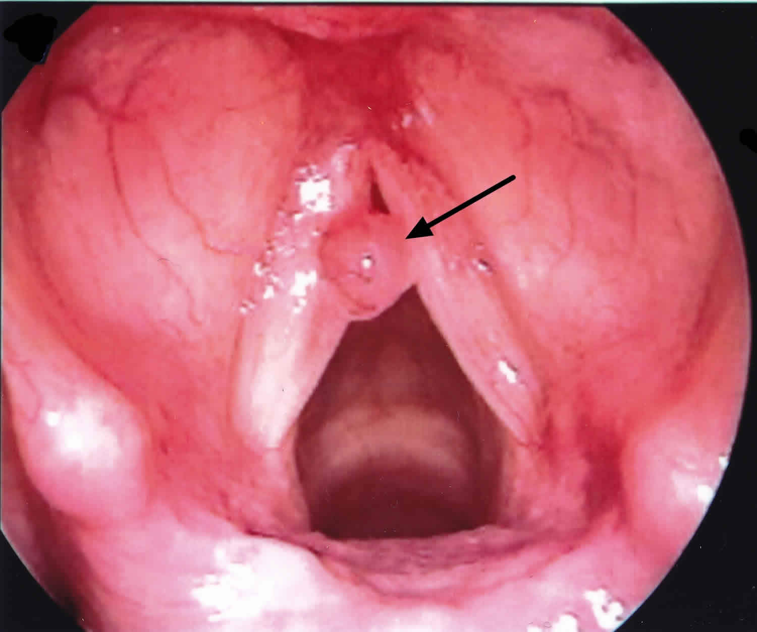 Vocal nodules causes, symptoms, diagnosis, treatment & prognosis