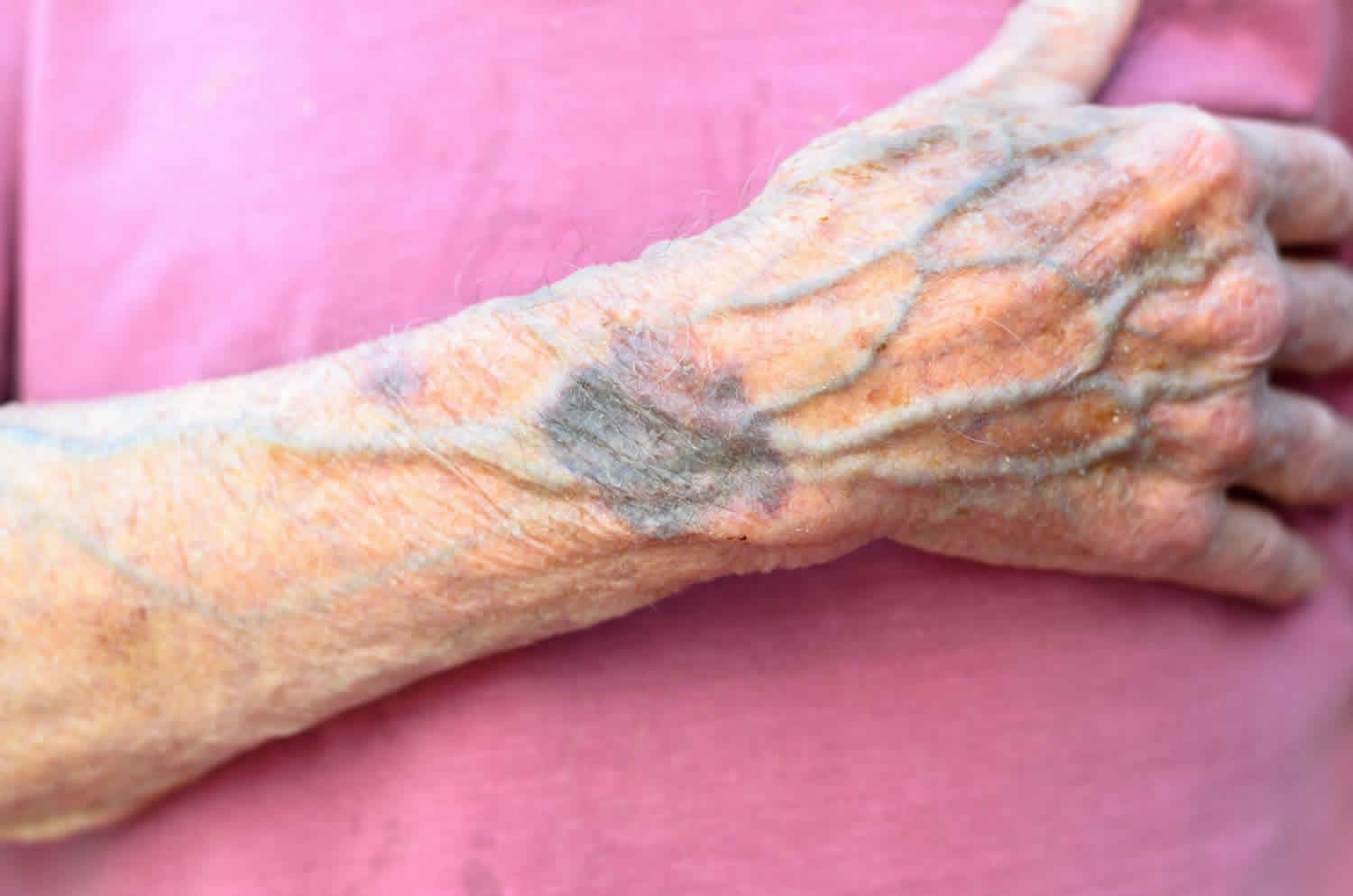 Collapsed Vein Arm