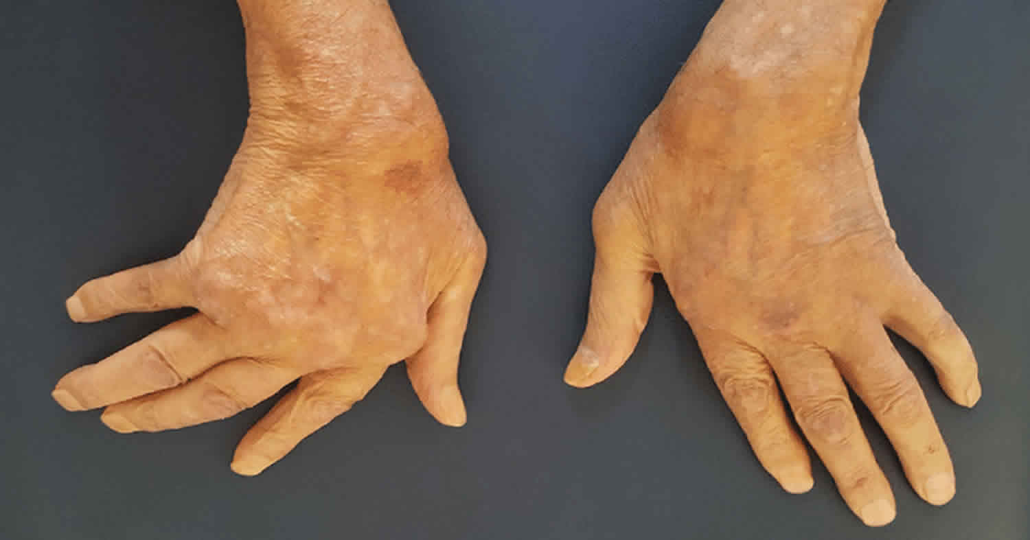 Ulnar deviation and ulnar drift definition and causes