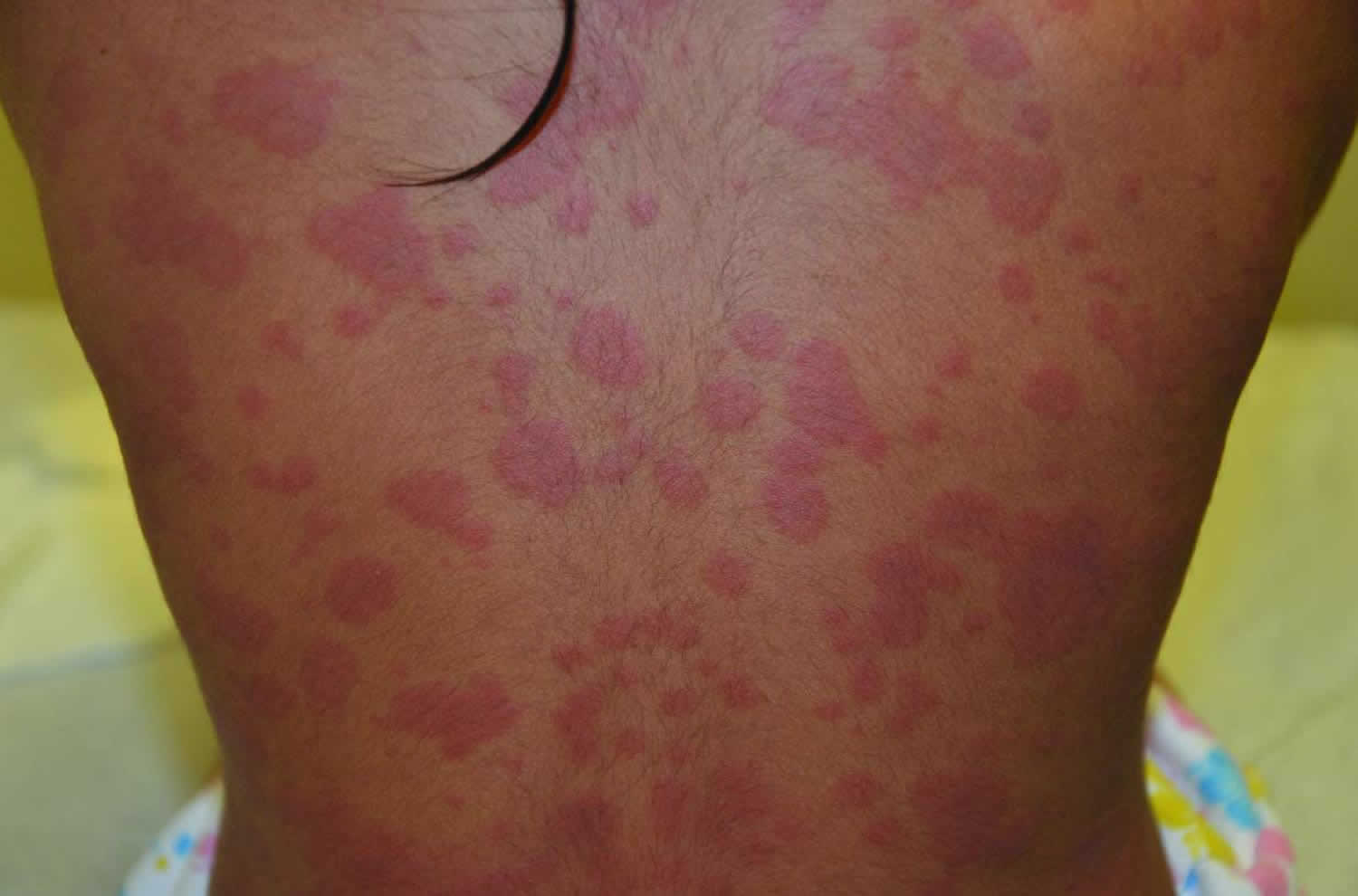 Urticaria multiforme causes, symptoms, diagnosis & treatment
