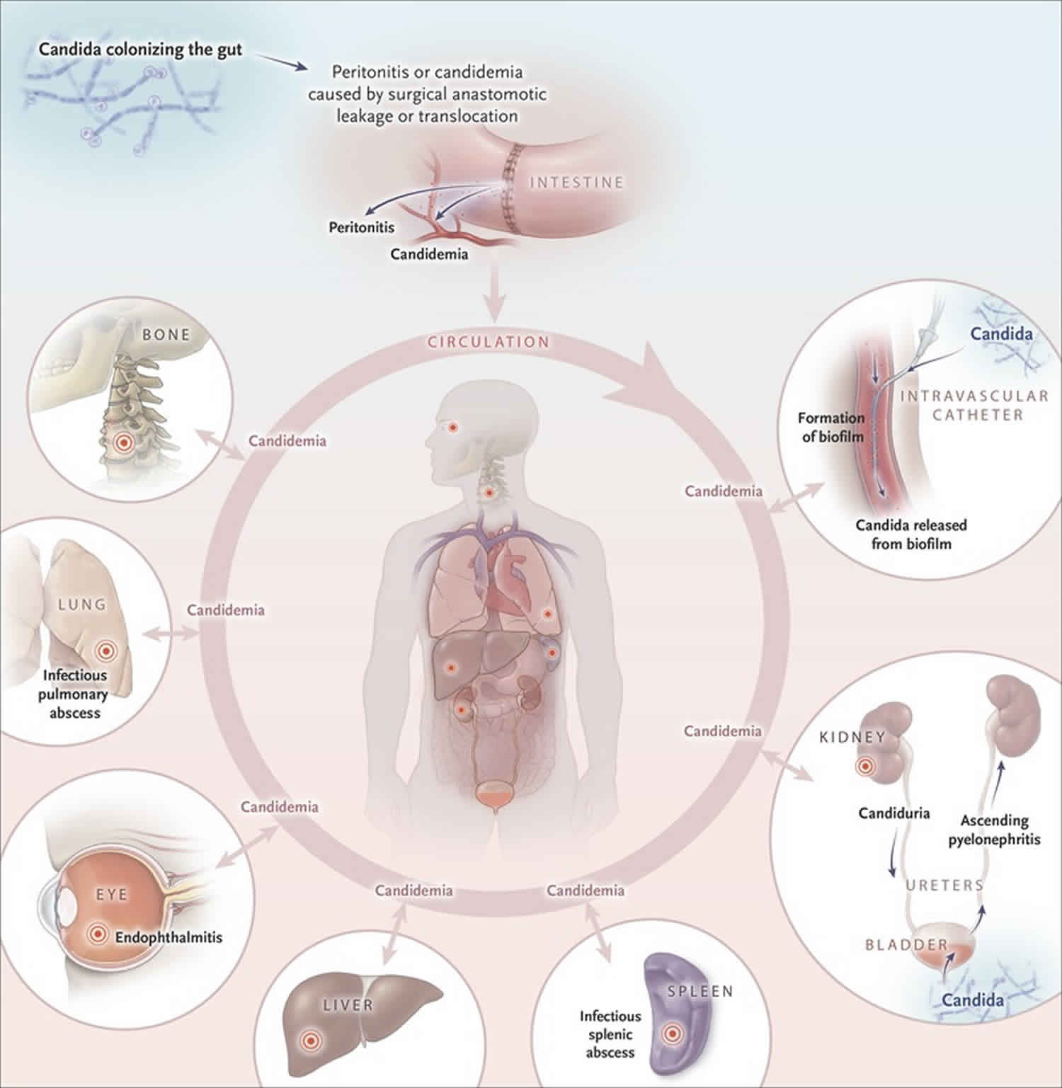 Systemic candidiasis causes, symptoms, diagnosis, treatment & prognosis
