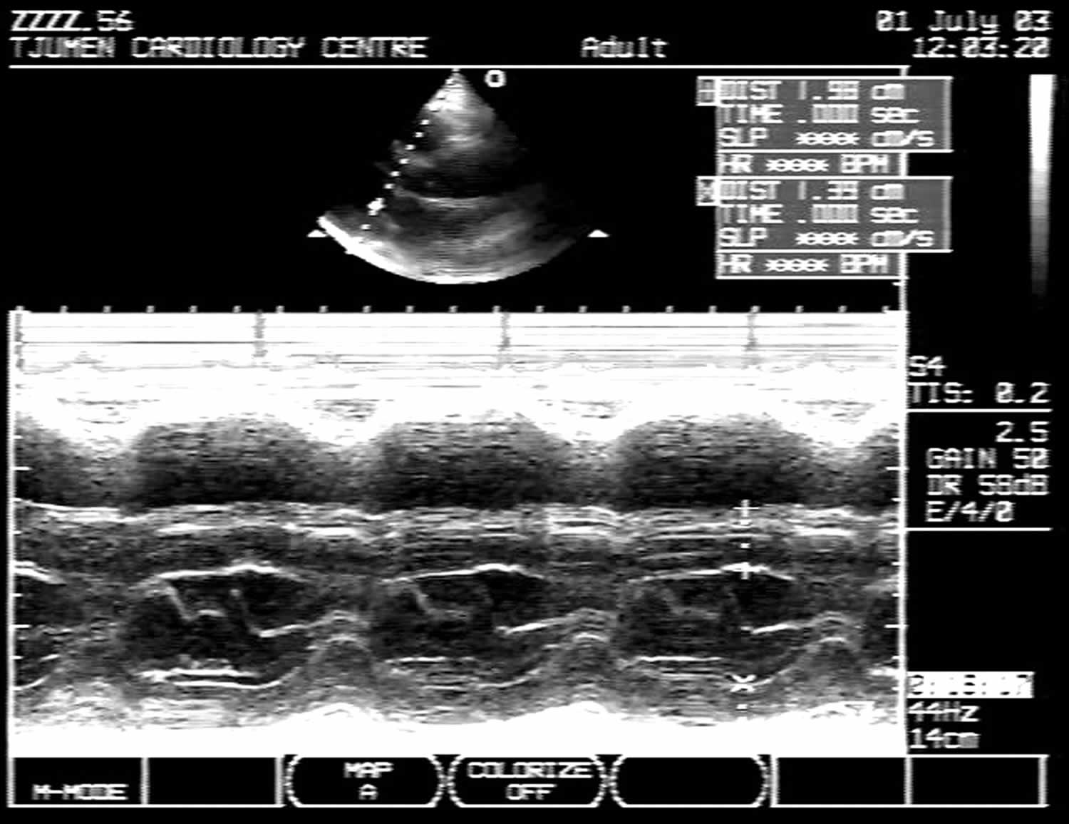 Asymmetric septal hypertrophy, definition, causes, symptoms, diagnosis