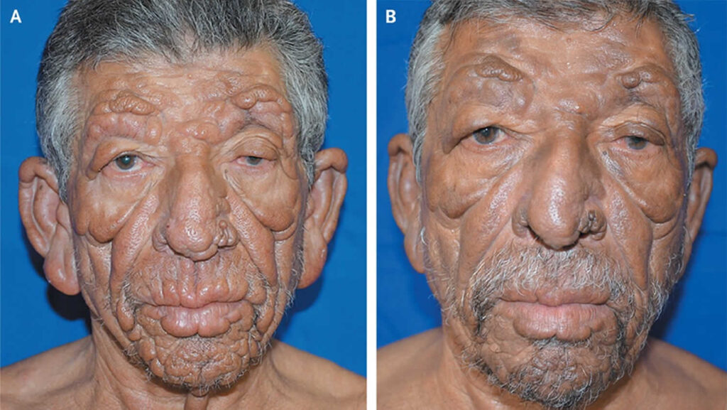 Lepromatous leprosy, definition, causes, symptoms, diagnosis, treatment