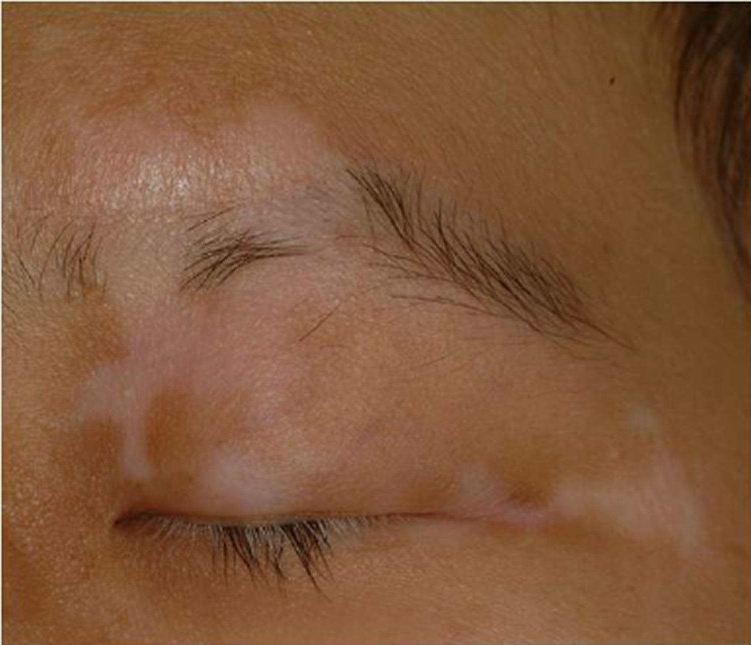 Segmental vitiligo, causes, symptoms, diagnosis, treatment & prognosis