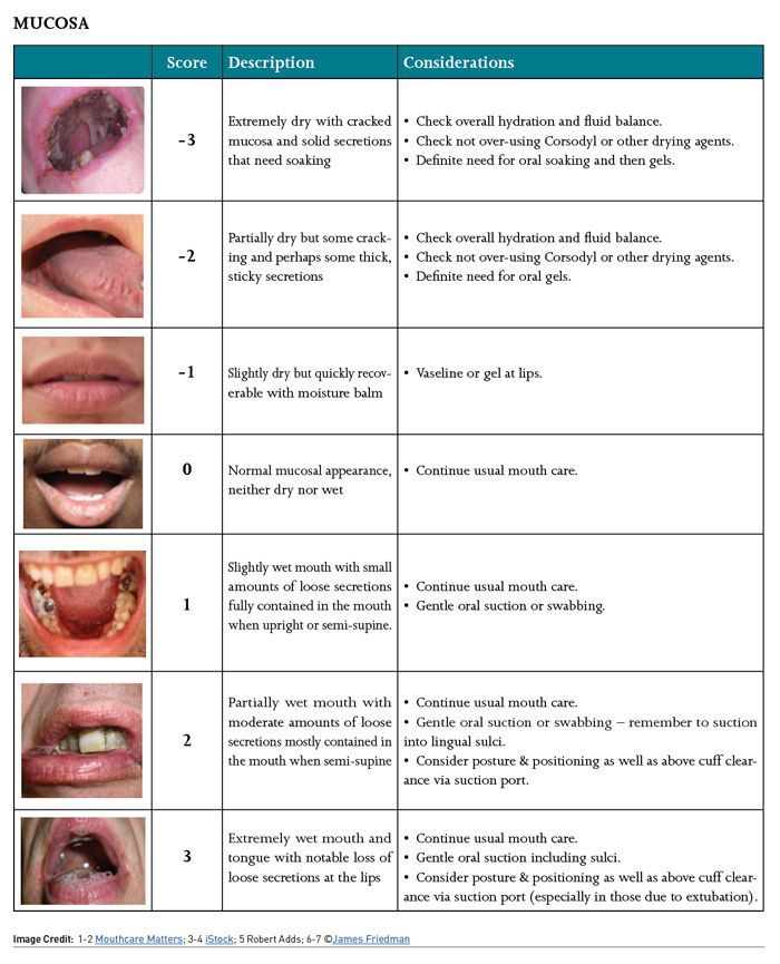Mouth Care Challenges and the Use of the COVID19 Oral Grading System