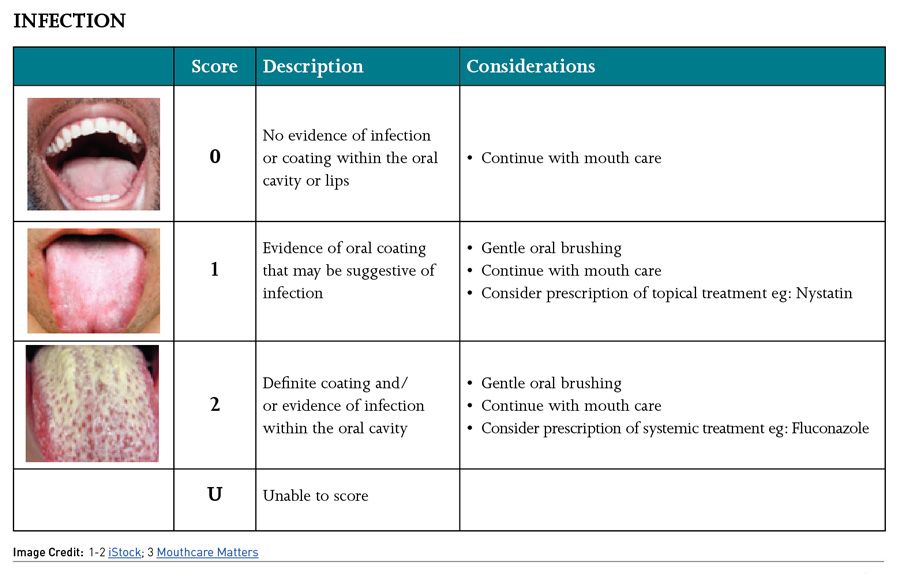 Mouth Care Challenges and the Use of the COVID19 Oral Grading System