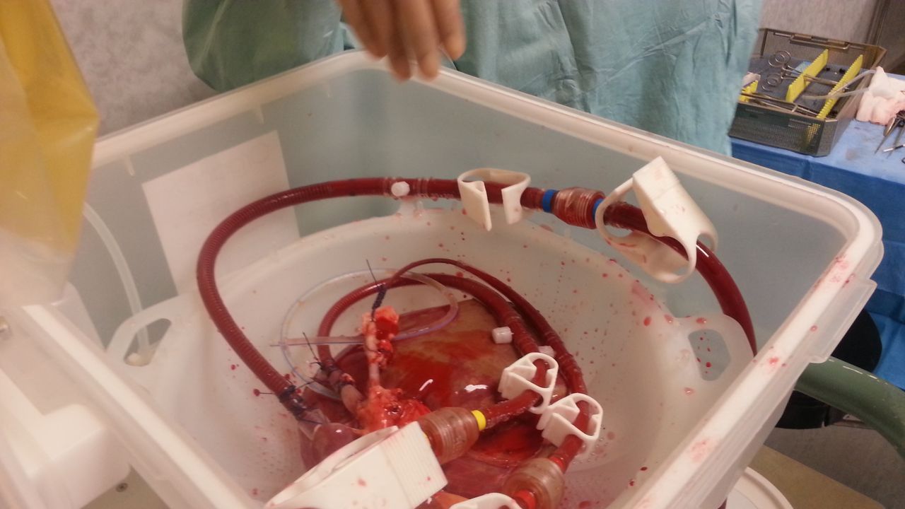 Device Keeps Human Liver Alive Outside Body