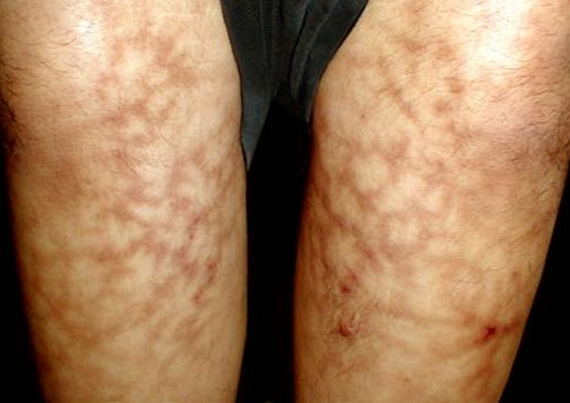 Livedo Reticularis (Mottling Skin) Causes, Pictures, Treatment