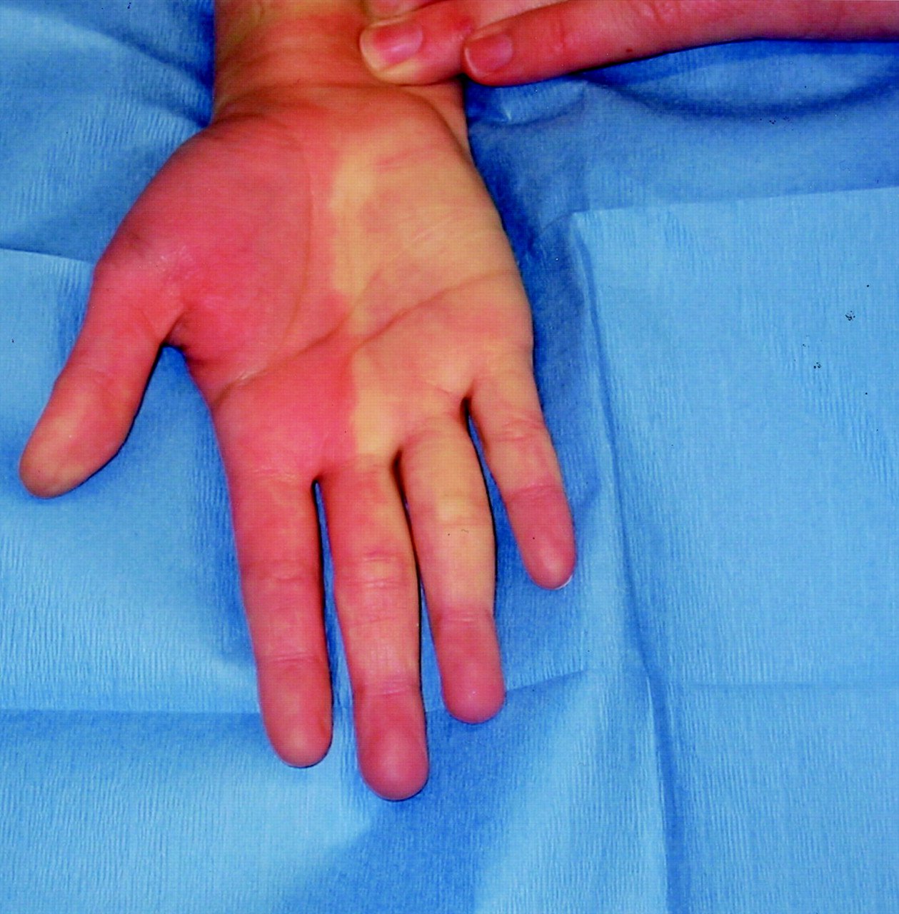 Allen test Procedure, Results, Types, Positive Allen test