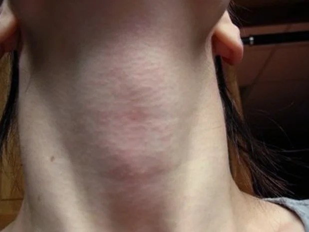 Healthool Itchy neck Pictures, Symptoms, Treatment, Rash