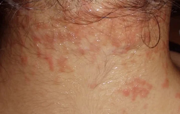 Healthool Itchy neck Pictures, Symptoms, Treatment, Rash