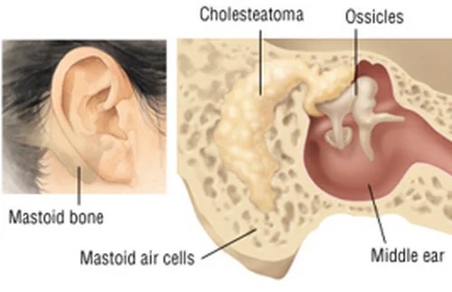 Lump Behind Ear Hard, Painful, small, swollen, on ear lobe