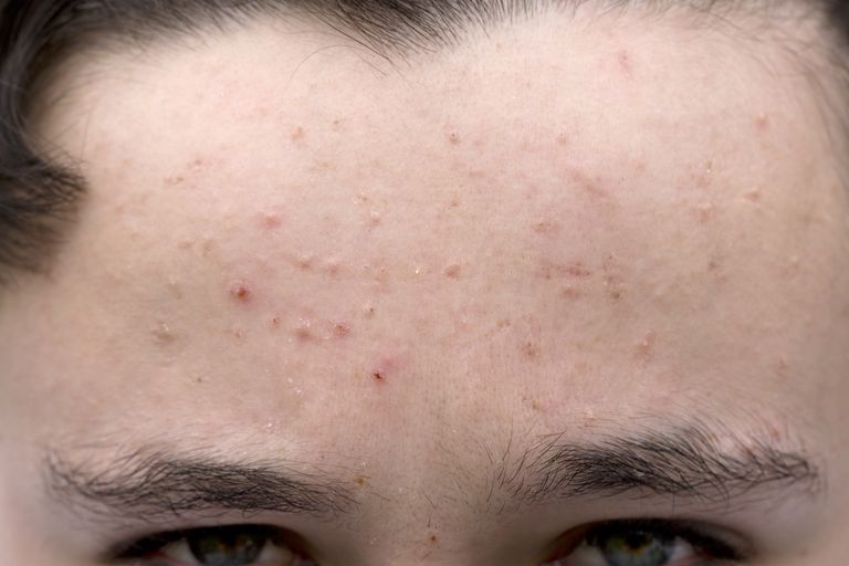 Forehead acne removal naturally Best Tips HealthPulls