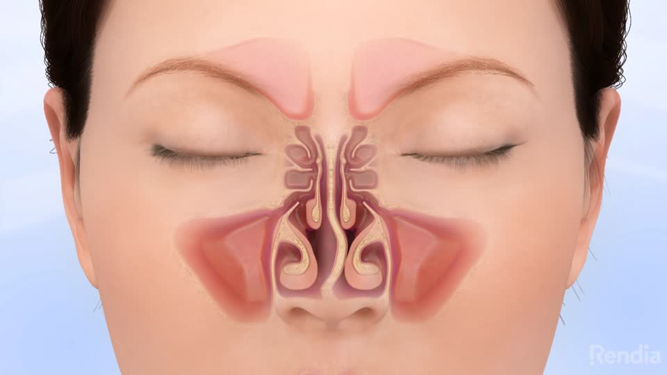 Nasal Septum Deviation Causes, Types and Treatment
