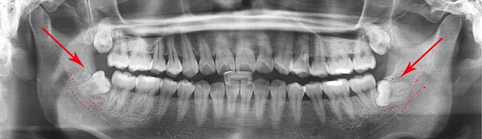 Tooth Extraction Cost and Other Dental Services Included