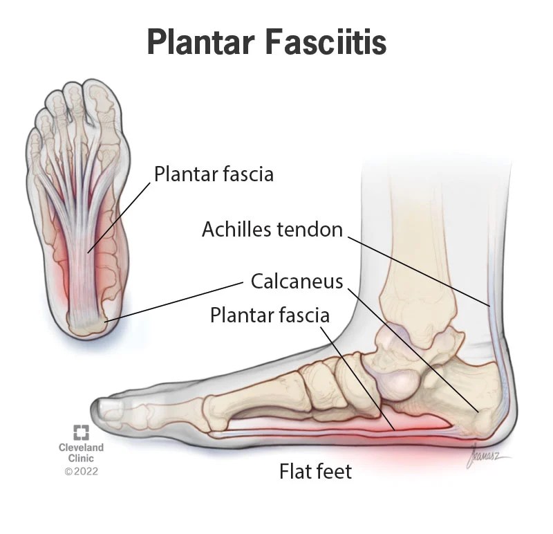 Plantar Fasciitis So Bad I Can't Walk