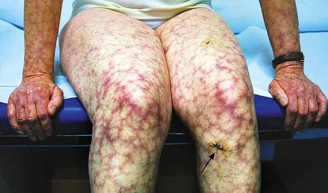 Livedo Reticularis Causes, Pictures, Treatment, Symptoms