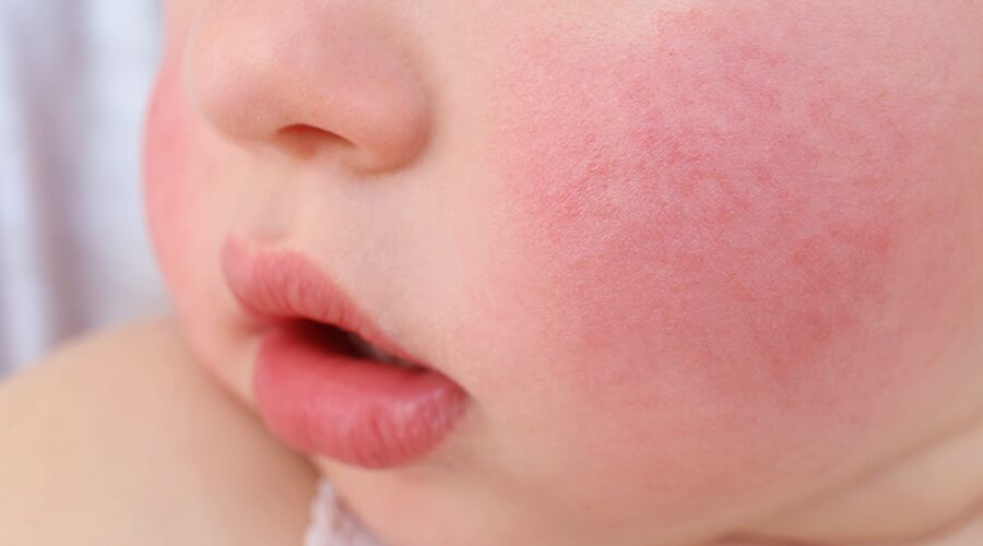 Flushed Cheeks In Adults