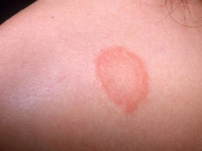 Skin Rashes Causes, Symptoms and Effective Home Remedies Healthtian