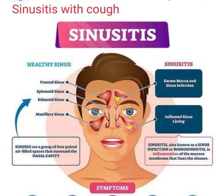 Sinusitis With Cough