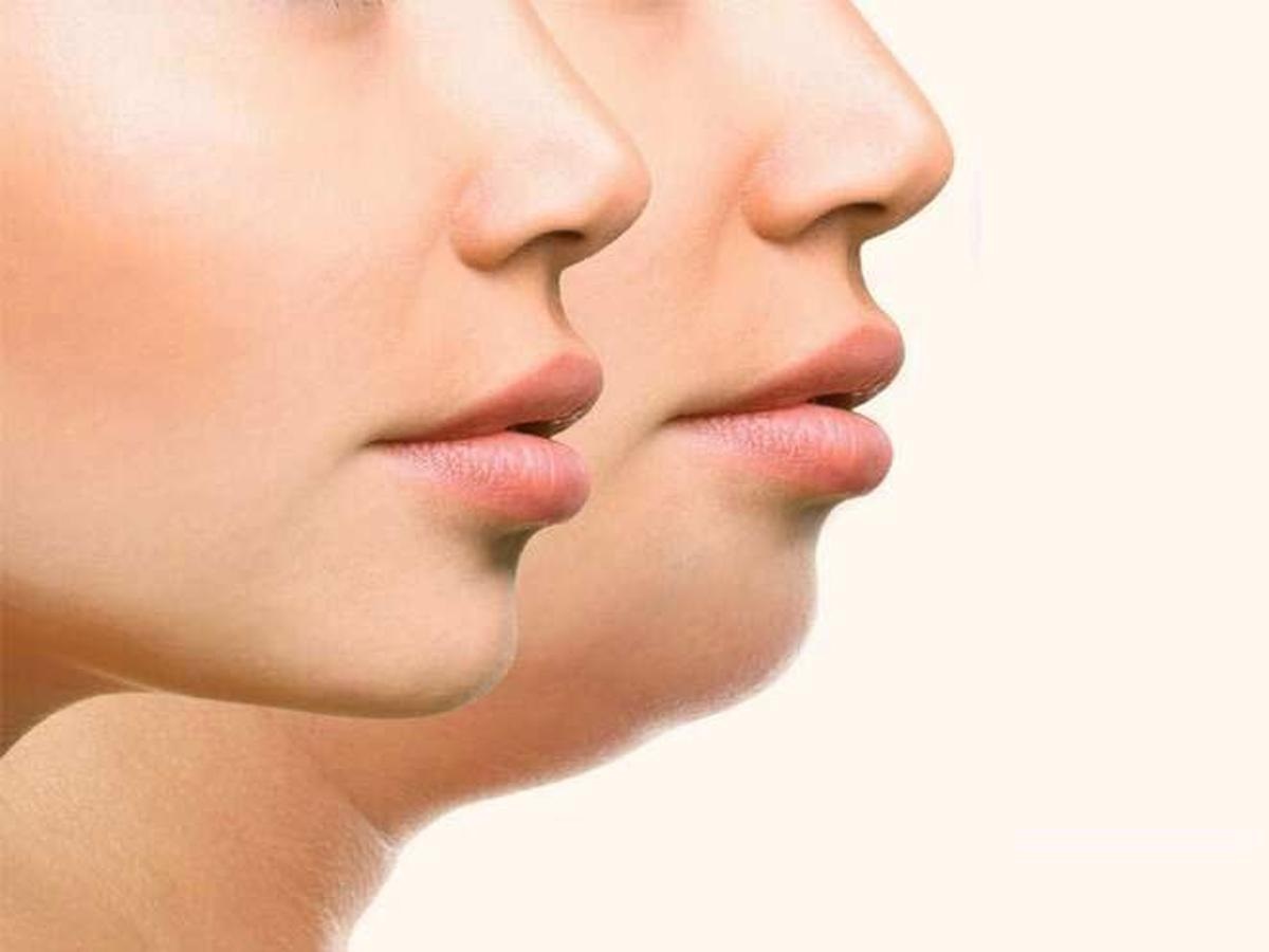 Fat Cheeks Causes and Treatments Healthy Ideal