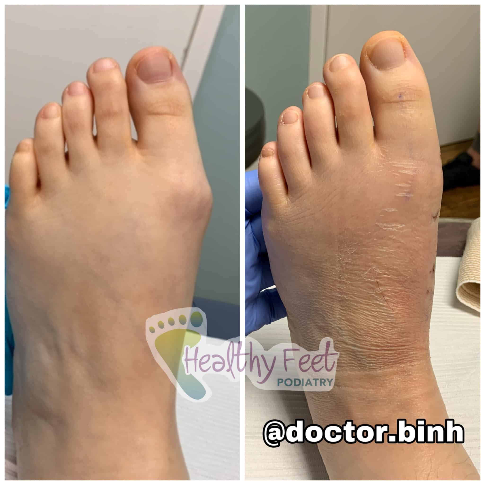 Minimally Invasive Bunion Surgery Wesley Chapel FL