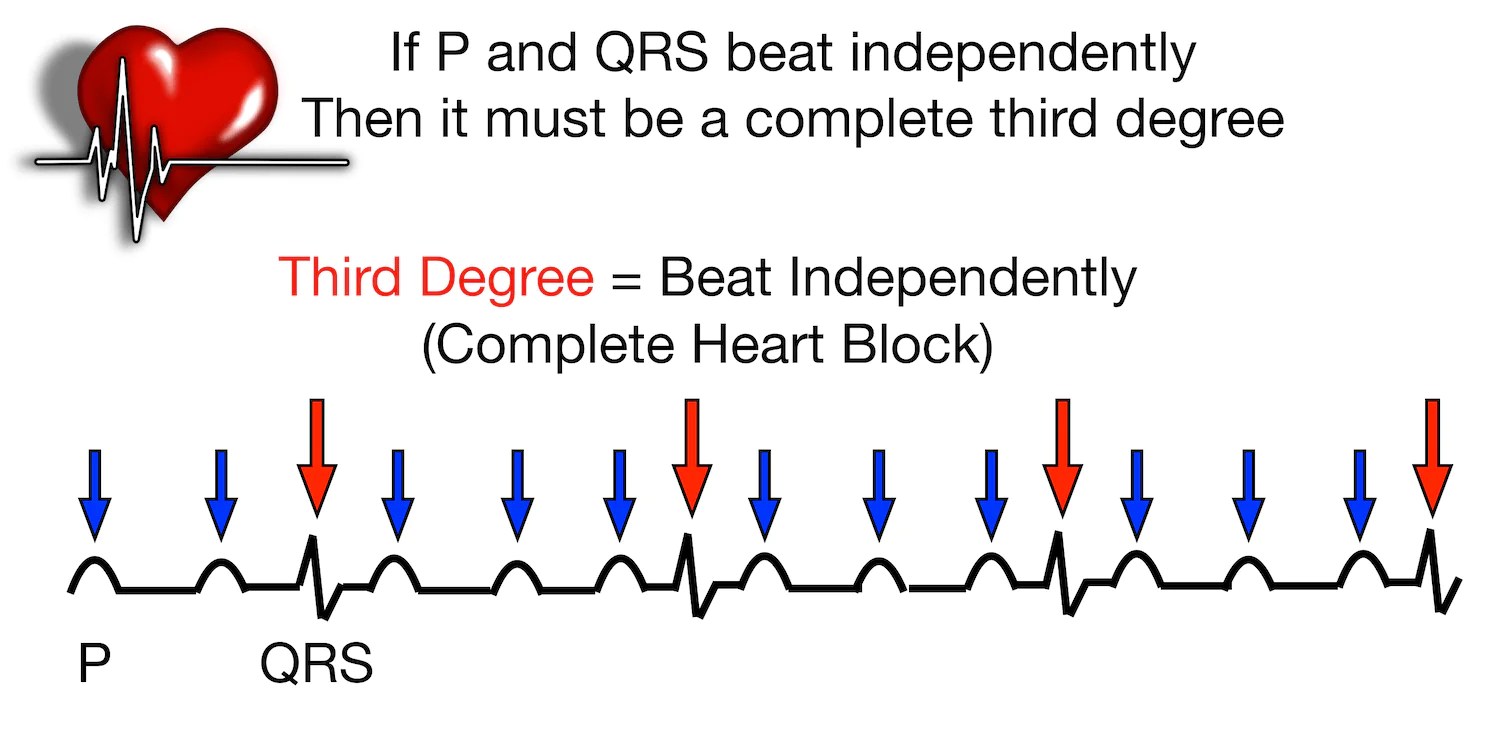 Complete Heart Block When the Heart Fails to Beat