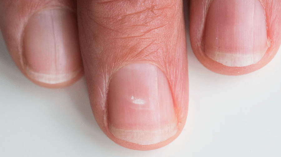 WHY DO WHITE SPOTS APPEAR ON YOUR NAILS Healthylicius