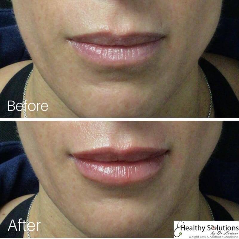 Lip Injections The Top 15 Frequently Asked Questions Answered