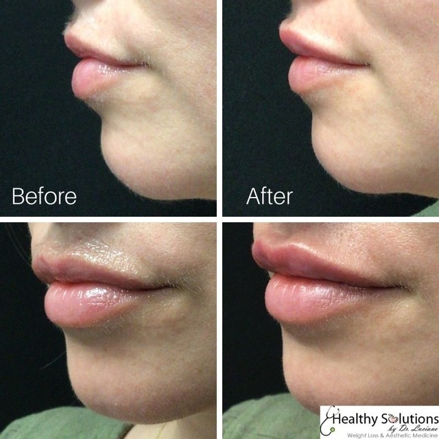 Lip Injections Before and After Photos Healthy Solutions Medspa