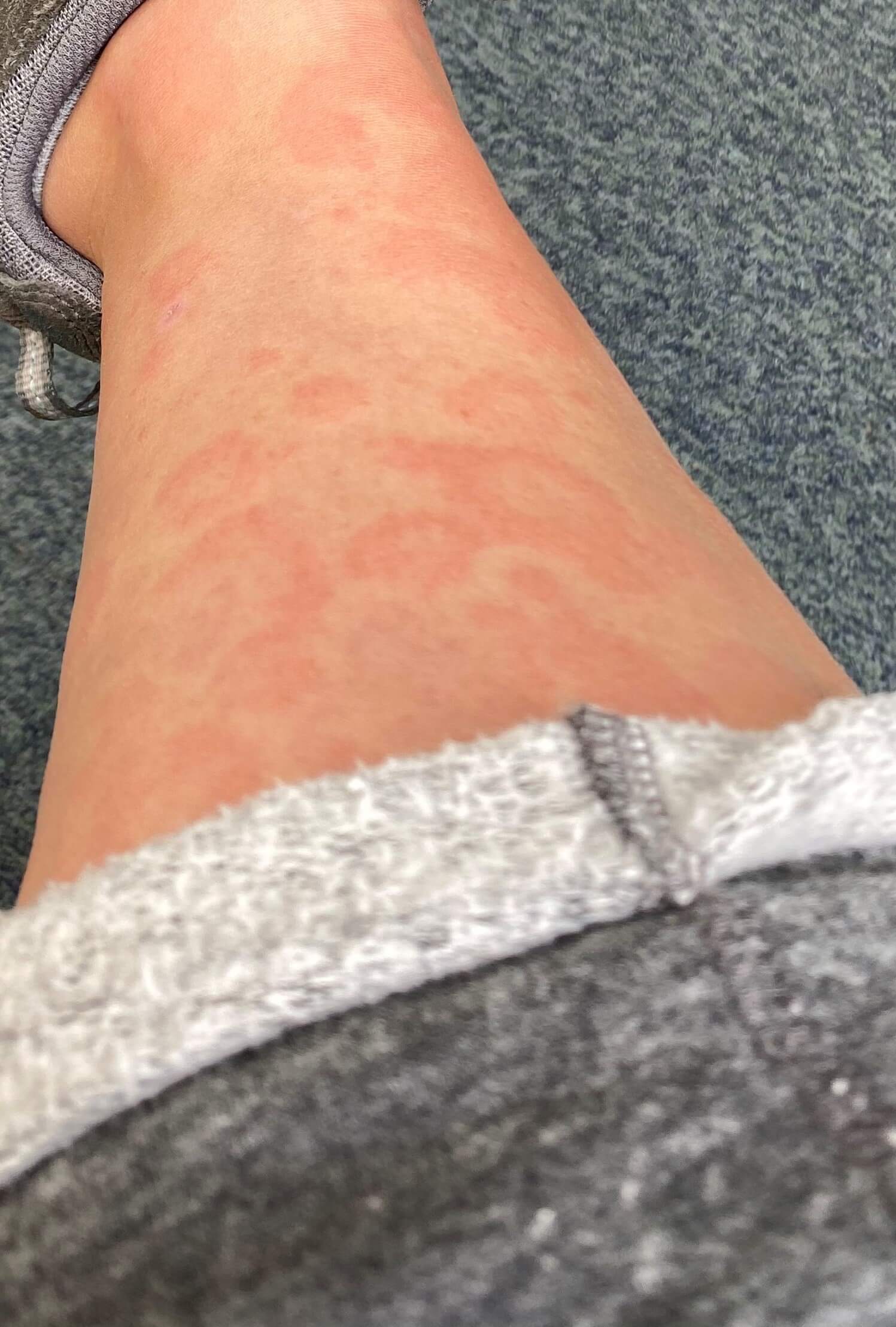 COVID19 Symptoms Three Skin Rashes to Look For