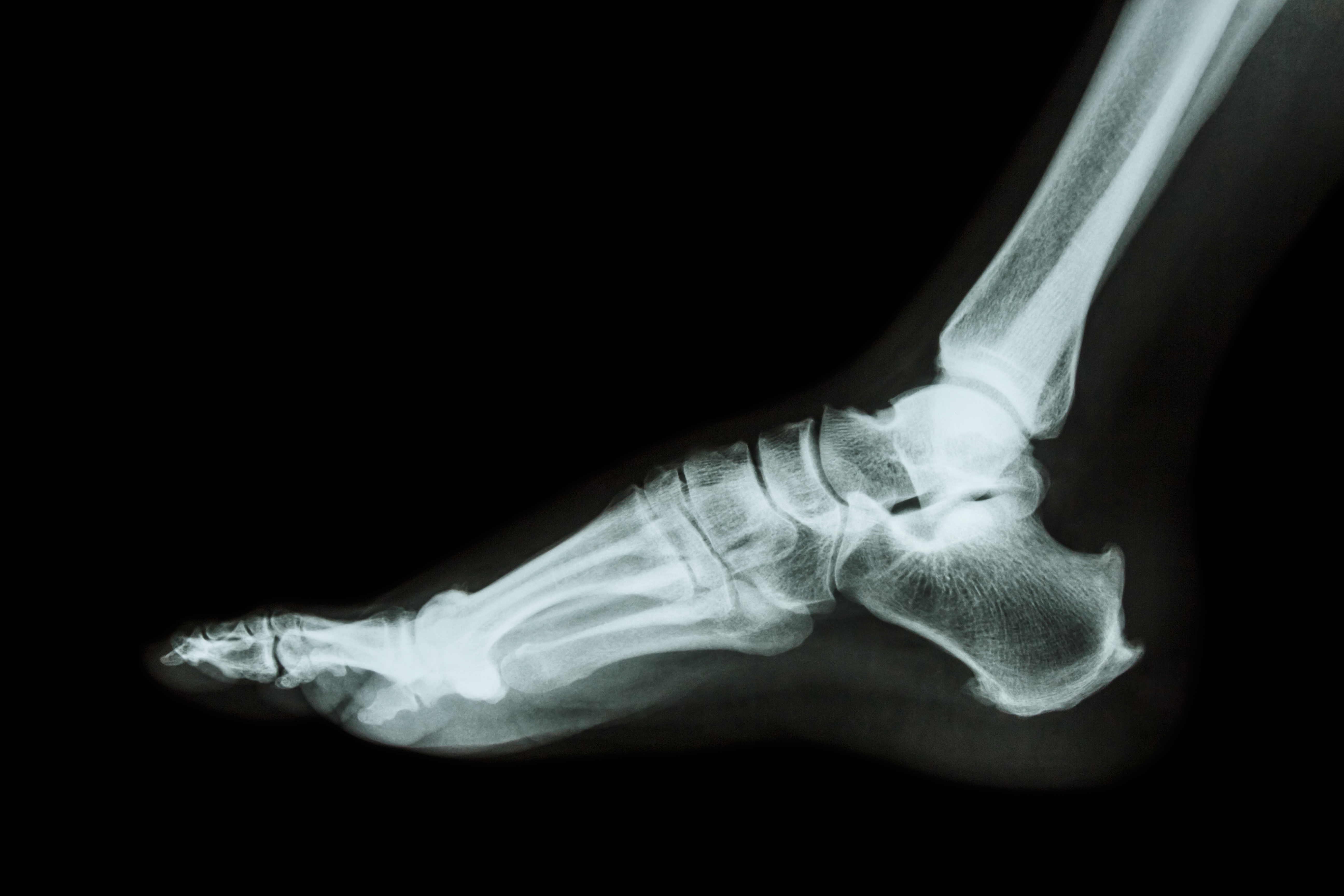 Everything You Need to Know About Xrays for Heel Pain